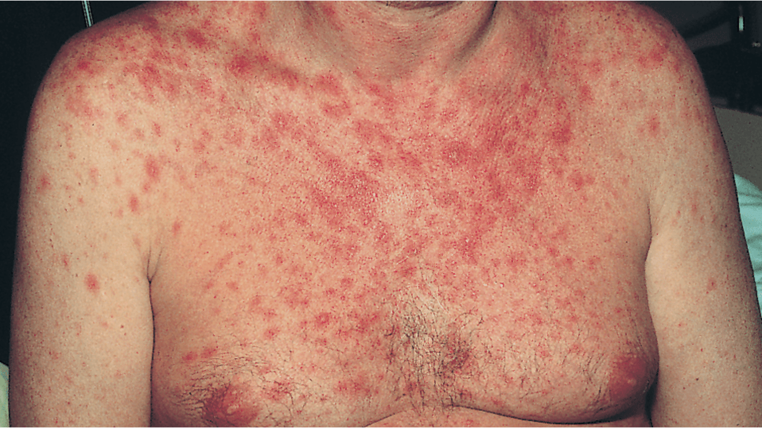 HIV upper Body Rash