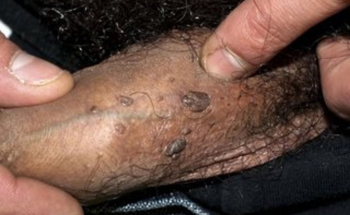Men Genital Warts
