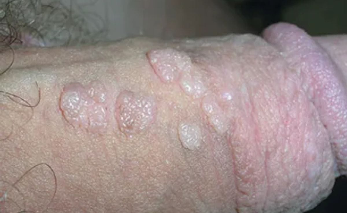 Genital warts HPV