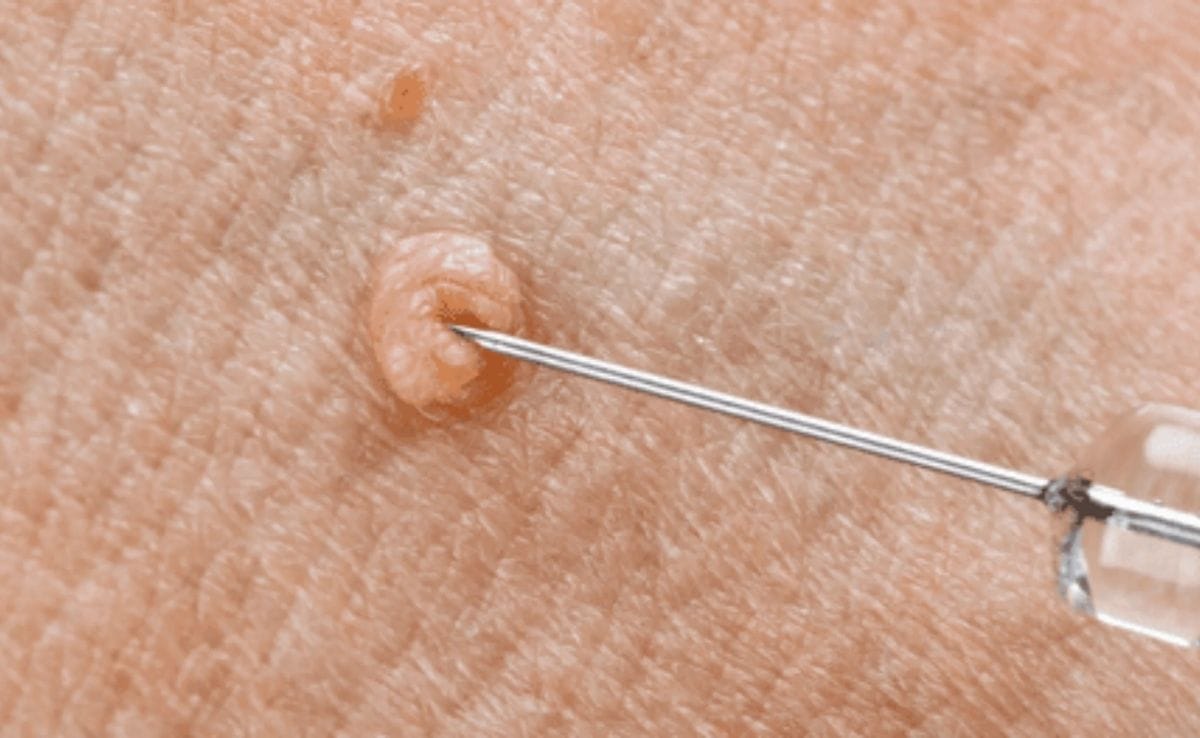 Needle Wart removal