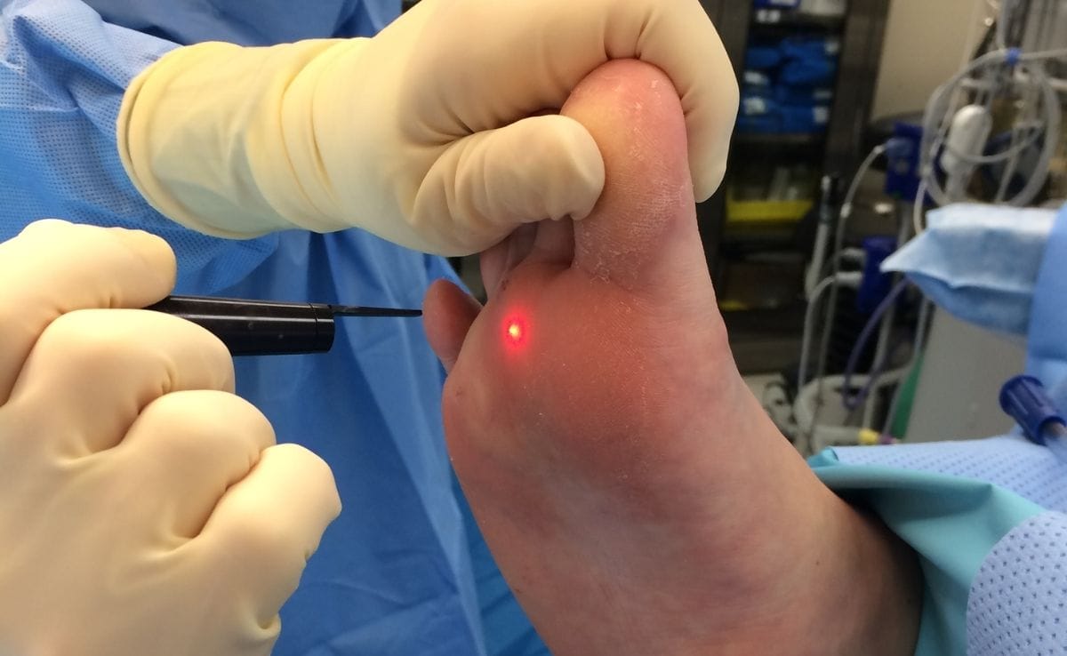 Laser Wart Removal
