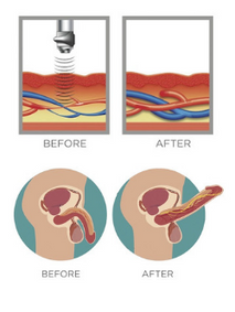 Effect of shockwave towards the blood flow before and after shockwave therapy