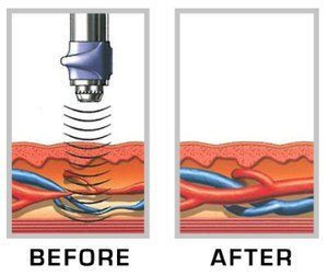 Effect of shockwave towards the blood flow before and after shockwave therapy