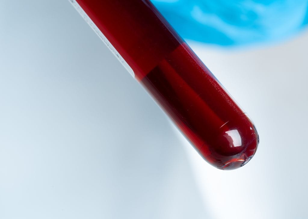 Blood plasma drawn from a patient for P Shot treatment.