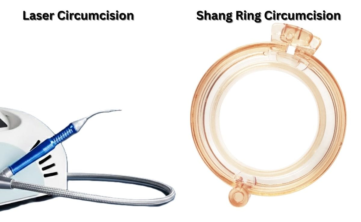 Laser Circumcision and Shang Ring CIrcumcision