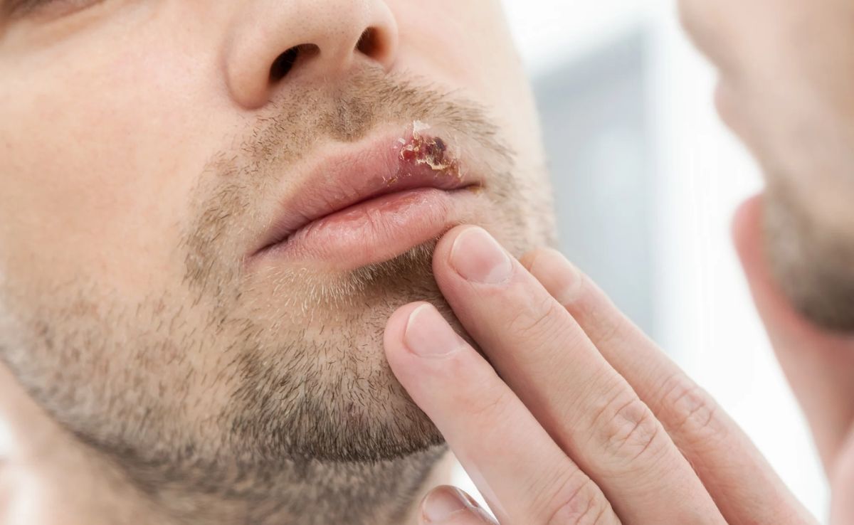 Herpes Viral Shedding