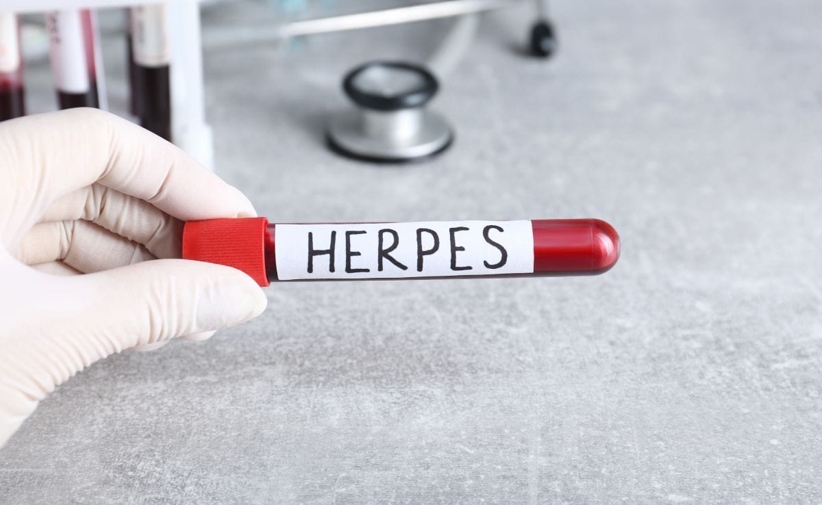 Genital Herpes blood tests diagnosis