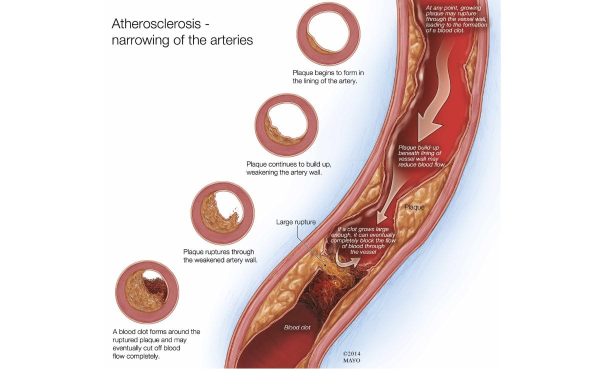 Mati Pucuk: Panduan Lengkap untuk Lelaki Malaysia 3 Mengapa Mati Pucuk (ED) Berlaku: Punca Utama (atherosclerosis_